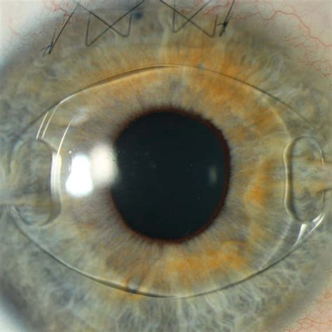 Phakic Intraocular Lens Implantation - Eye Specialists In Dubai