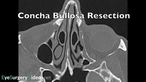 Concha-Bullosa - Oculoplastic | EyeSurgeryVideos.net