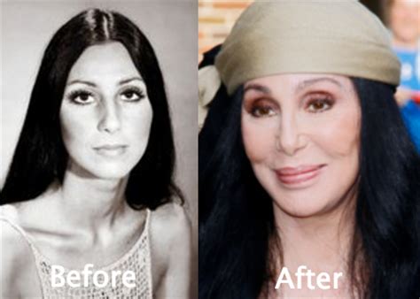 Cher Plastic Surgery Before and After Photos