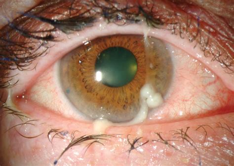 Conjunctivitis: Making the Call