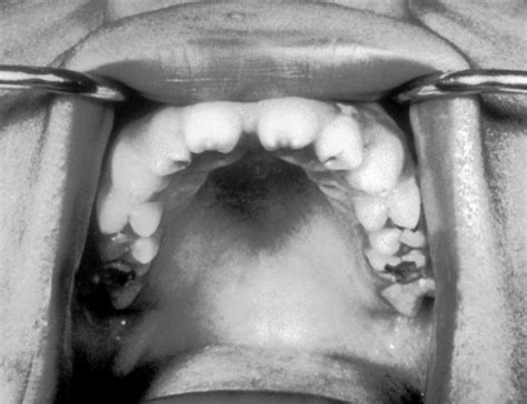 Hutchinson's teeth - Alchetron, The Free Social Encyclopedia