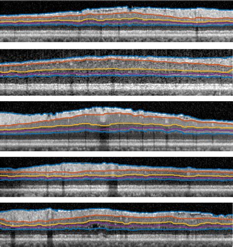 Figure 2 from Retinal layers segmentation using Fully Convolutional Network in OCT images ...