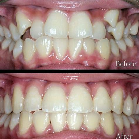 Invisible Braces - Before and After www.360orthodontics.com | Invisible braces, Braces before ...