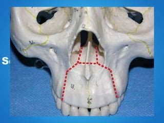 Lefort 1 osteotomy