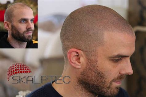 Scalp Micropigmentation or Hair Transplant Surgery | Skalptec UK | SMP