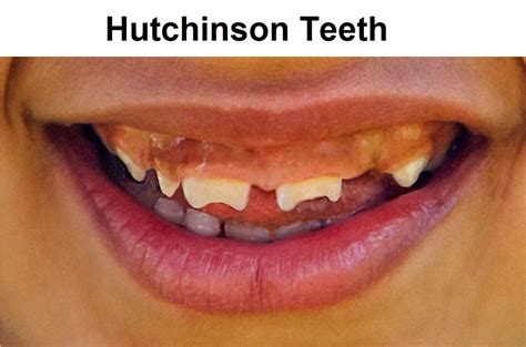 What are Hutchinson Teeth? | News | Dentagama