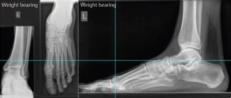 Subtalar Joint Fusion | Musculoskeletal Key