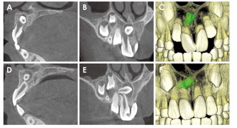 A case shows the development of mesiodens-related complication over ...