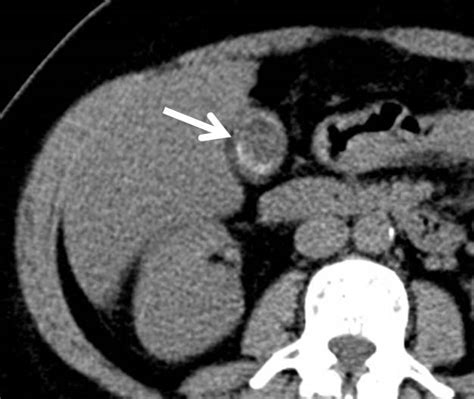 Porcelain gallbladder – Radiology Cases