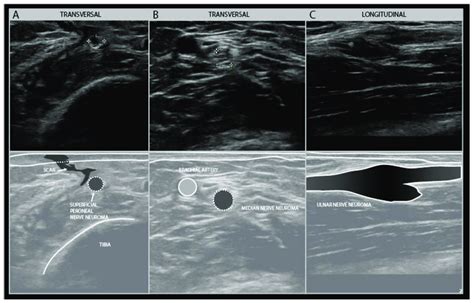 Examples of traumatic neuroma in continuity. Transverse view of a small... | Download Scientific ...