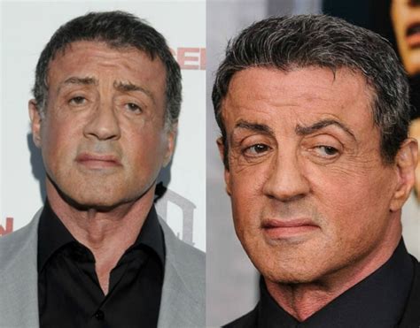 Sylvester Stallone before and after plastic surgery 07 – Celebrity ...