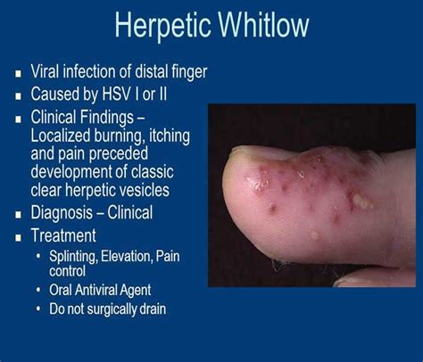 Herpetic Whitlow Finger Treatment