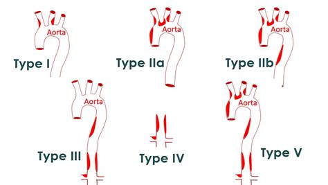 Angiographic classification of Takayasu arteritis – All About ...