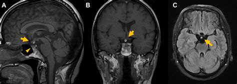 Normal Pituitary Mri