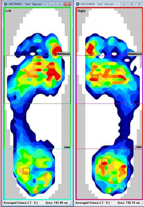 Force Plate & Pressure Technology for Biomechanical Analysis | Tekscan