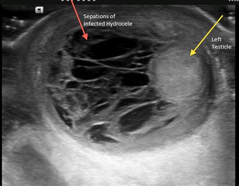 Idiopathic Infant Pyocele: A Case Report and Review of the Literature ...