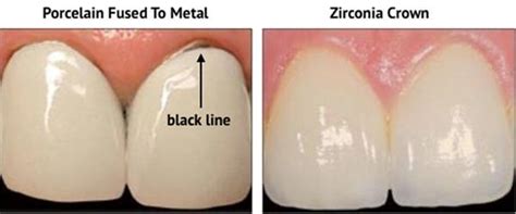 Zirconia Dental Crowns Century City Smiles And Orthodontics Dentists ...