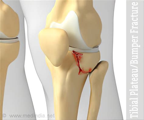 Bumper fracture - Alchetron, The Free Social Encyclopedia