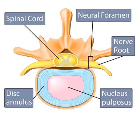 The Difference Between Bulging Disc and Herniated Disc (2022)