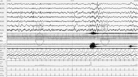 Figure showing a 60-sec epoch from a polysomnogram done on one of my... | Download Scientific ...