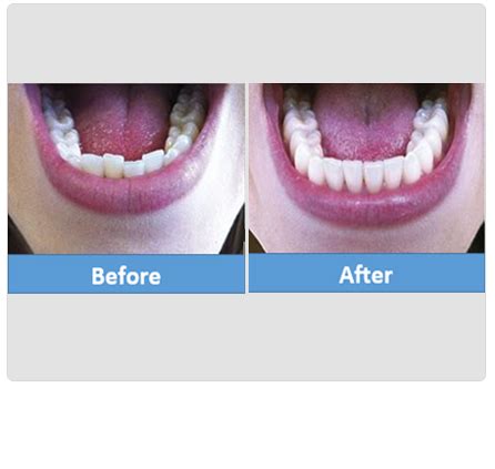 Misaligned Teeth Treatment Ahmedabad | Orthodontist Paldi | US Dental