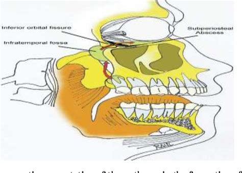 Maxillary third molar and Subperiosteal abscess of the orbit: unusual and unnoticed complication ...