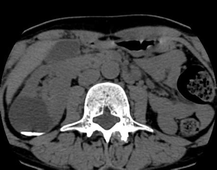 Renal milk of calcium cyst | Radiology Case | Radiopaedia.org