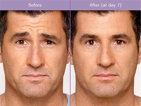 Botox Before After Photos | Wrinkle Remover Dallas, Plano, Texas