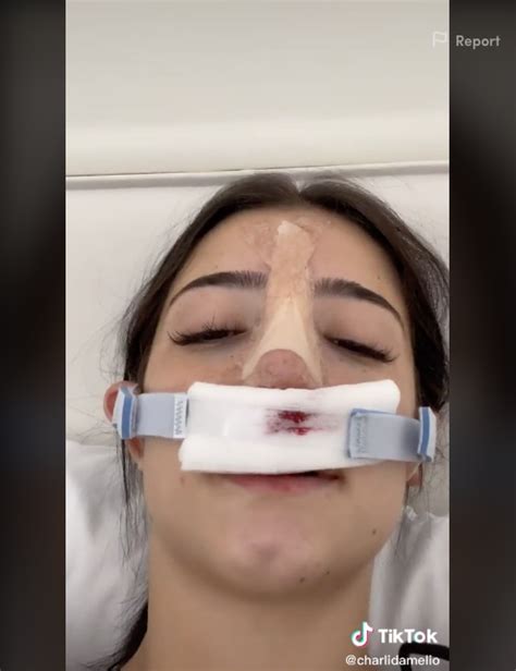 Why did TikTok star Charli D’Amelio have surgery? – The US Sun | The US Sun