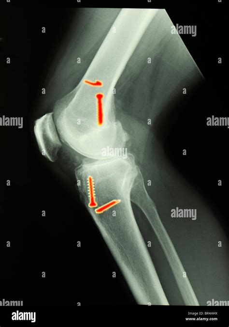 knee x-ray of a 45 year old man who had surgery to repair a torn ACL ...