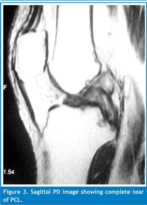 MRI evaluation of knee injury with arthroscopic correlation. | Semantic Scholar