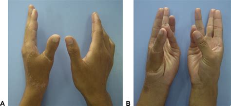 Follow-up photographs 1 year after surgery. A Dorsal aspect of the... | Download Scientific Diagram