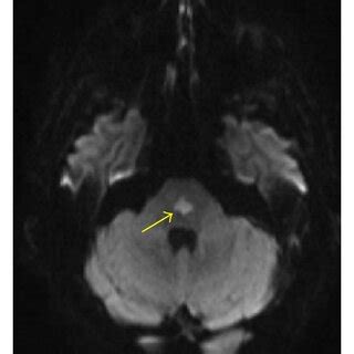 Brain magnetic resonance imaging shows a lesion in the central pons ...