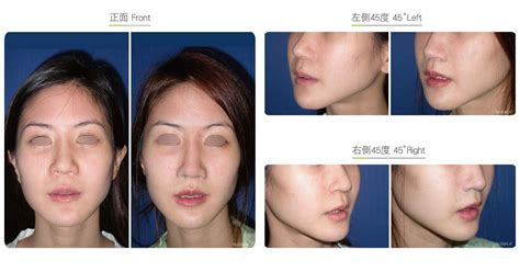 Philtrum Reduction-Facial Surgery | Wish Aesthetic Surgery Clinic