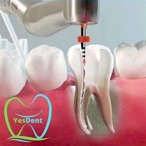 Devitalizzazione dei denti - Studio Dentistico YesDent | Dentisti Bergamo