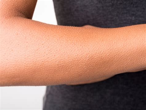 The Mystery behind Goosebumps | Healthy Living