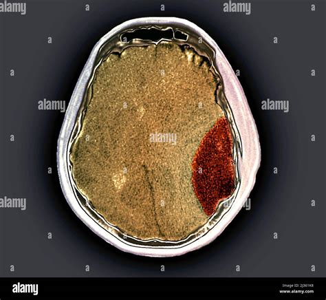 Skull fracture, CT scan Stock Photo - Alamy