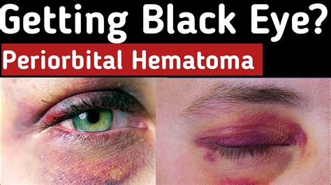 Getting a black eye- Periorbital Hematoma, What causes a black eye, Symptoms, Treatment ...