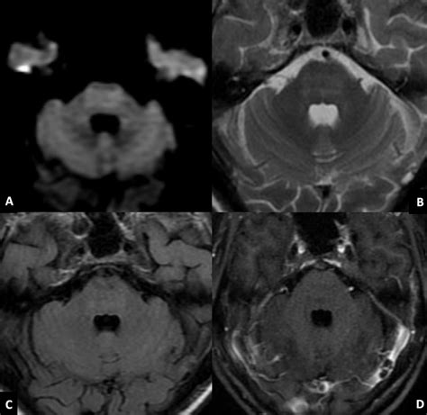 Brain MRI of the patient. Hyperintense signal in central pons with ...