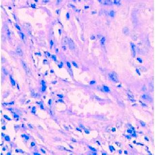 Histopathological picture of scrofuloderma with tuberculoid granuloma. | Download Scientific Diagram