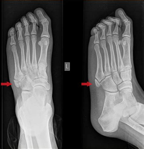 Cureus | Os Vesalianum Pedis in a Young Adult: A Case Report and Literature Review