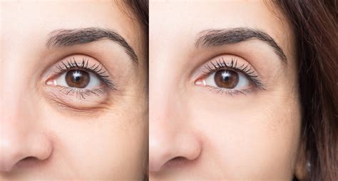 Undereye Filler And How To Tackle Undereye Hollowness | Blog | HUDA BEAUTY