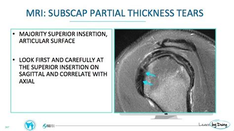 MRI Subscapularis Tears - Radedasia