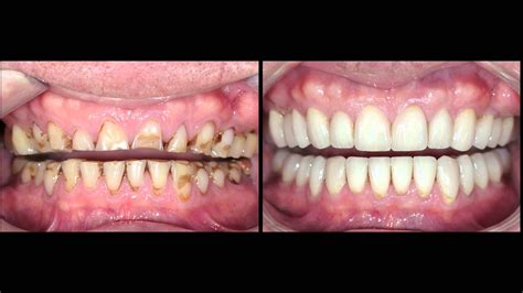 Full Mouth Rehab - drzanwar