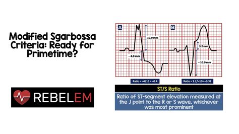 Modified Sgarbossa Criteria - REBEL EM - Emergency Medicine Blog