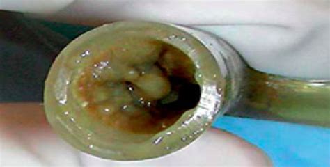 Formation of mucus plug within a stent. The inability to clear... | Download Scientific Diagram