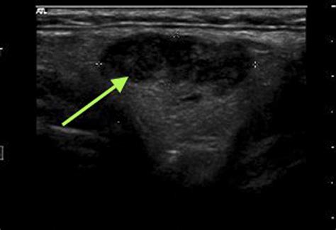 Lipoma Ultrasound Treatment - Infoupdate.org