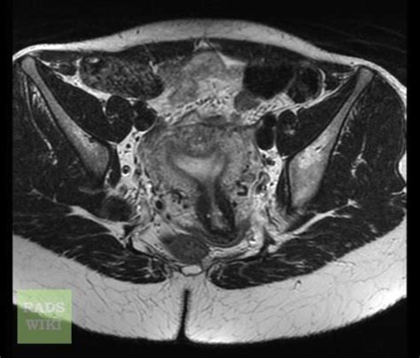 Arcuate uterus (MRI) - radRounds Radiology Network