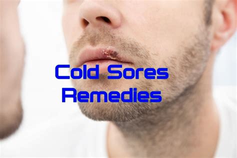 10 Home Remedies for Cold Sores - Home Remedies App