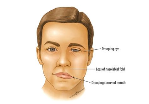 7 Early Warning Signs of a Stroke in Men and Women